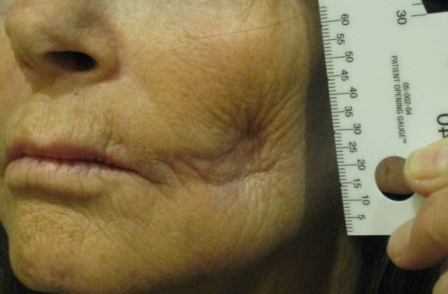 LIP AUGMENTATION GALLERY BEFORE