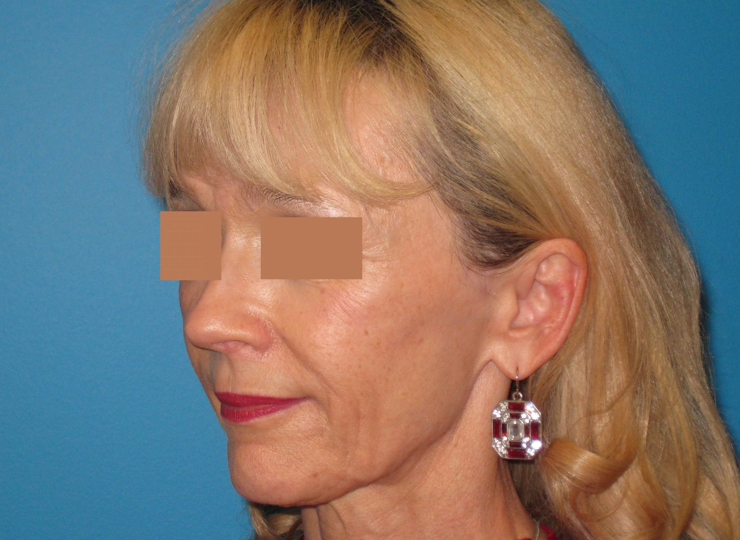 BEAUTIFY-LIFE LIFT GALLERY Before