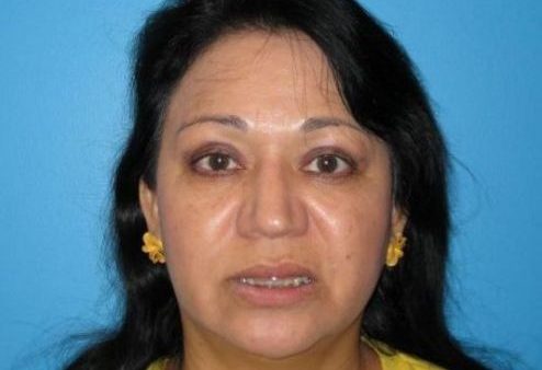 BEAUTIFY-LIFE LIFT GALLERY Before