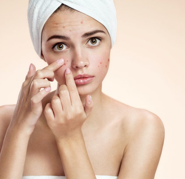 ACNE TREATMENT in West Jordan Utah