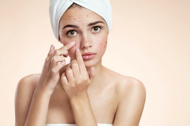 ACNE TREATMENT in West Jordan Utah