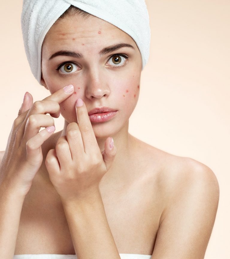 ACNE TREATMENT in West Jordan Utah