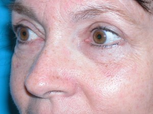 EYELID SURGERY GALLERY After