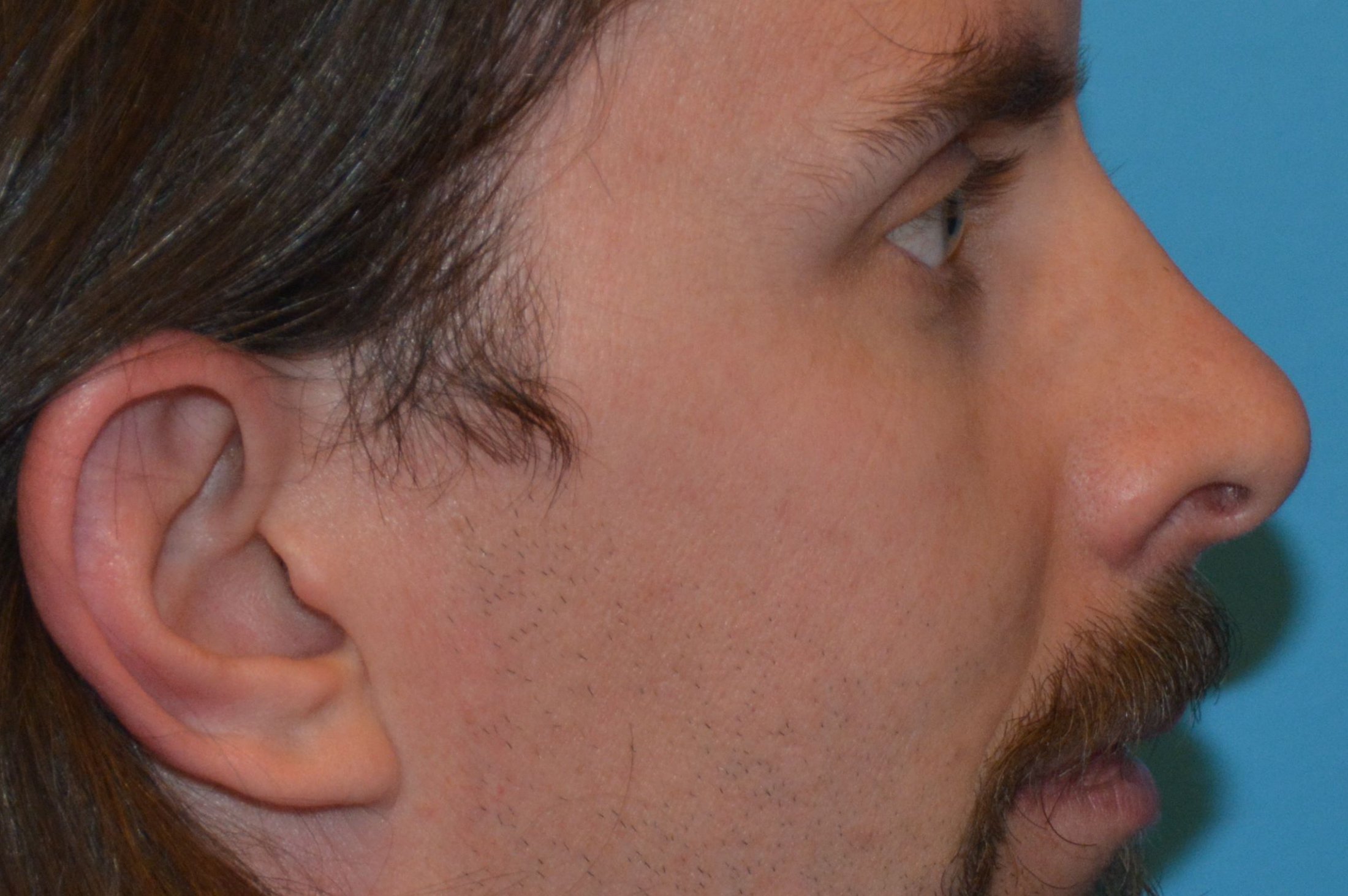 EAR AND EARLOBE Before EAR AND EARLOBE Before