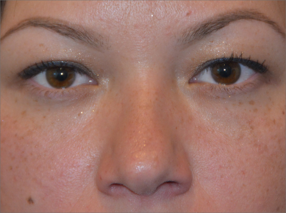 EYELID SURGERY Before