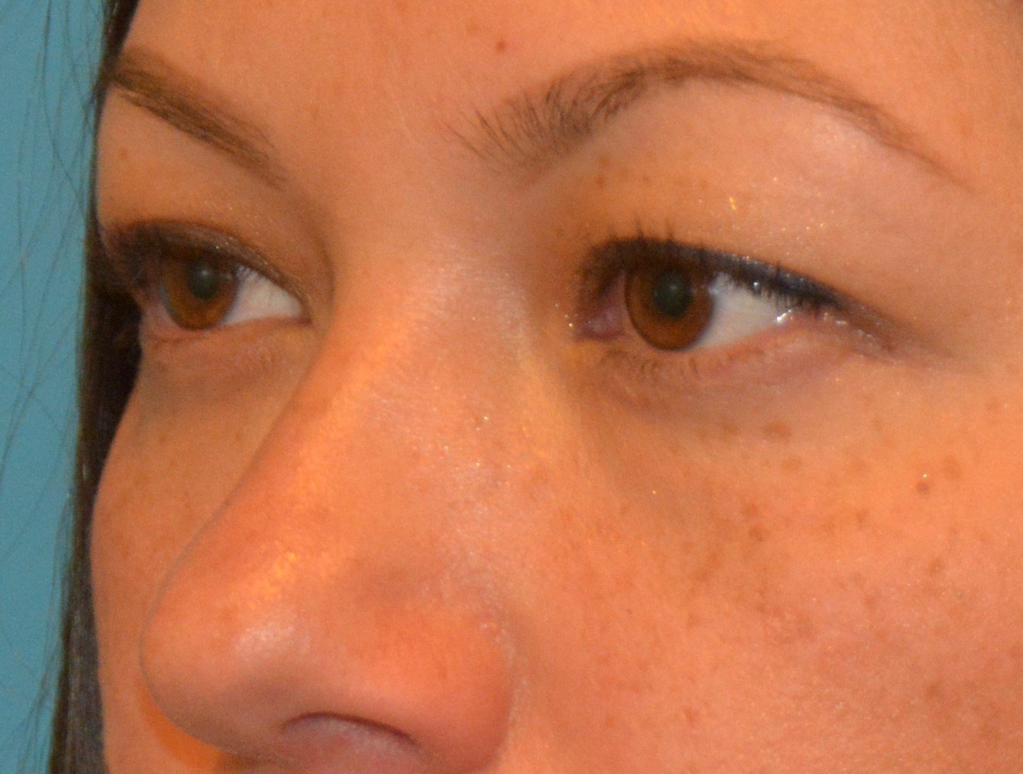 EYELID SURGERY Before