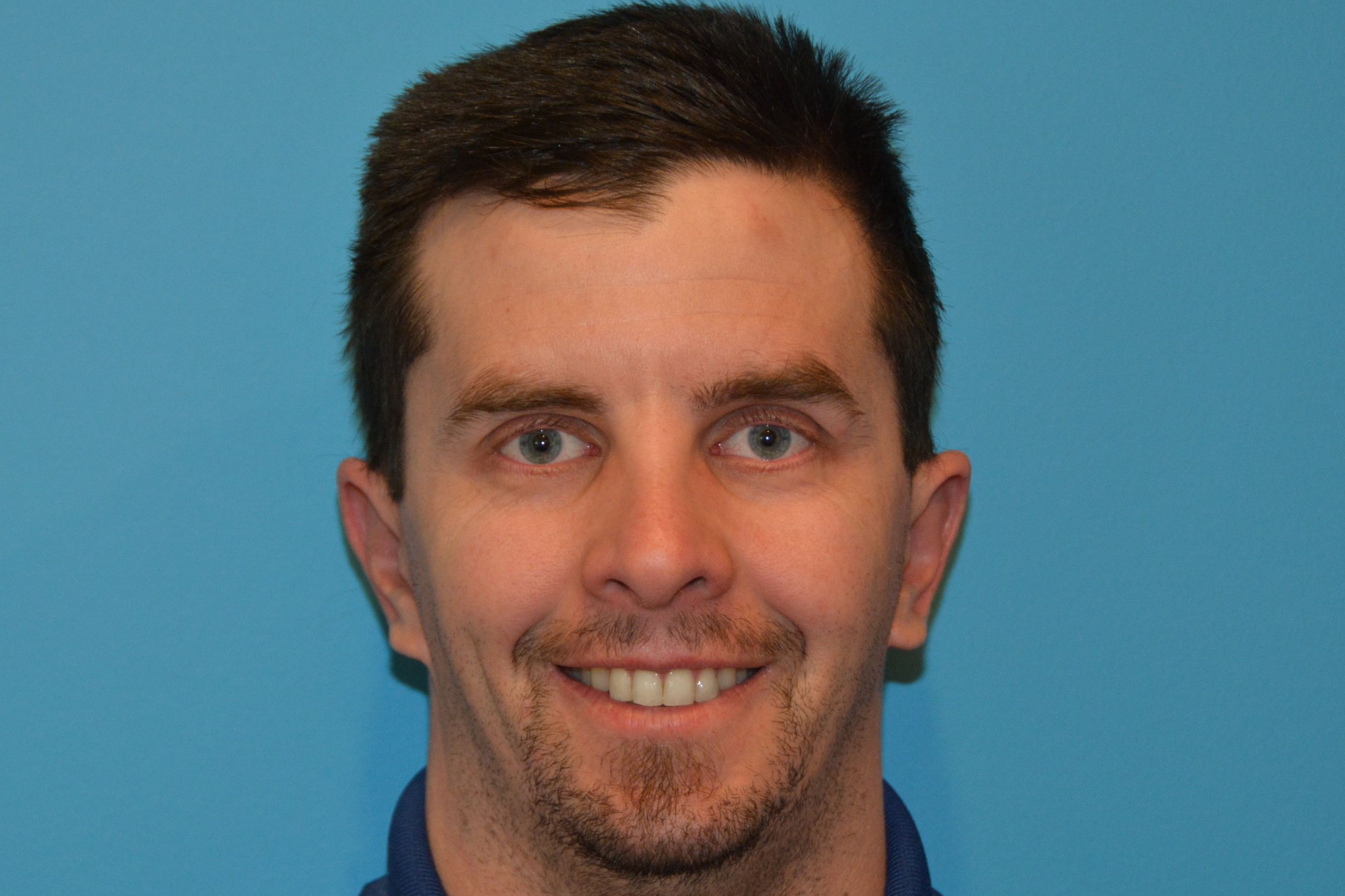 EAR AND EARLOBE After EAR AND EARLOBE After