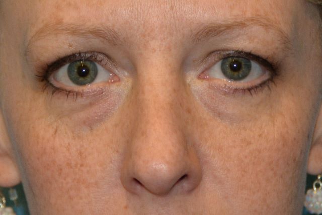 EYELID SURGERY GALLERY Before