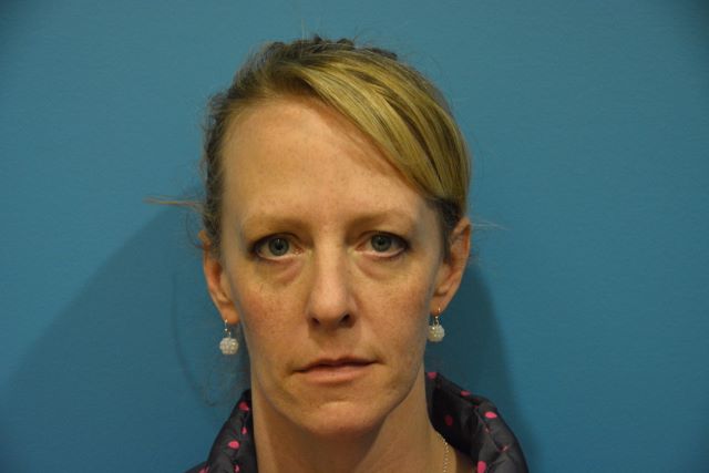 CO2 LASER SKIN RESURFACING BEFORE