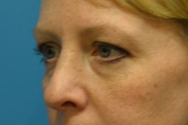 EYELID SURGERY GALLERY Before