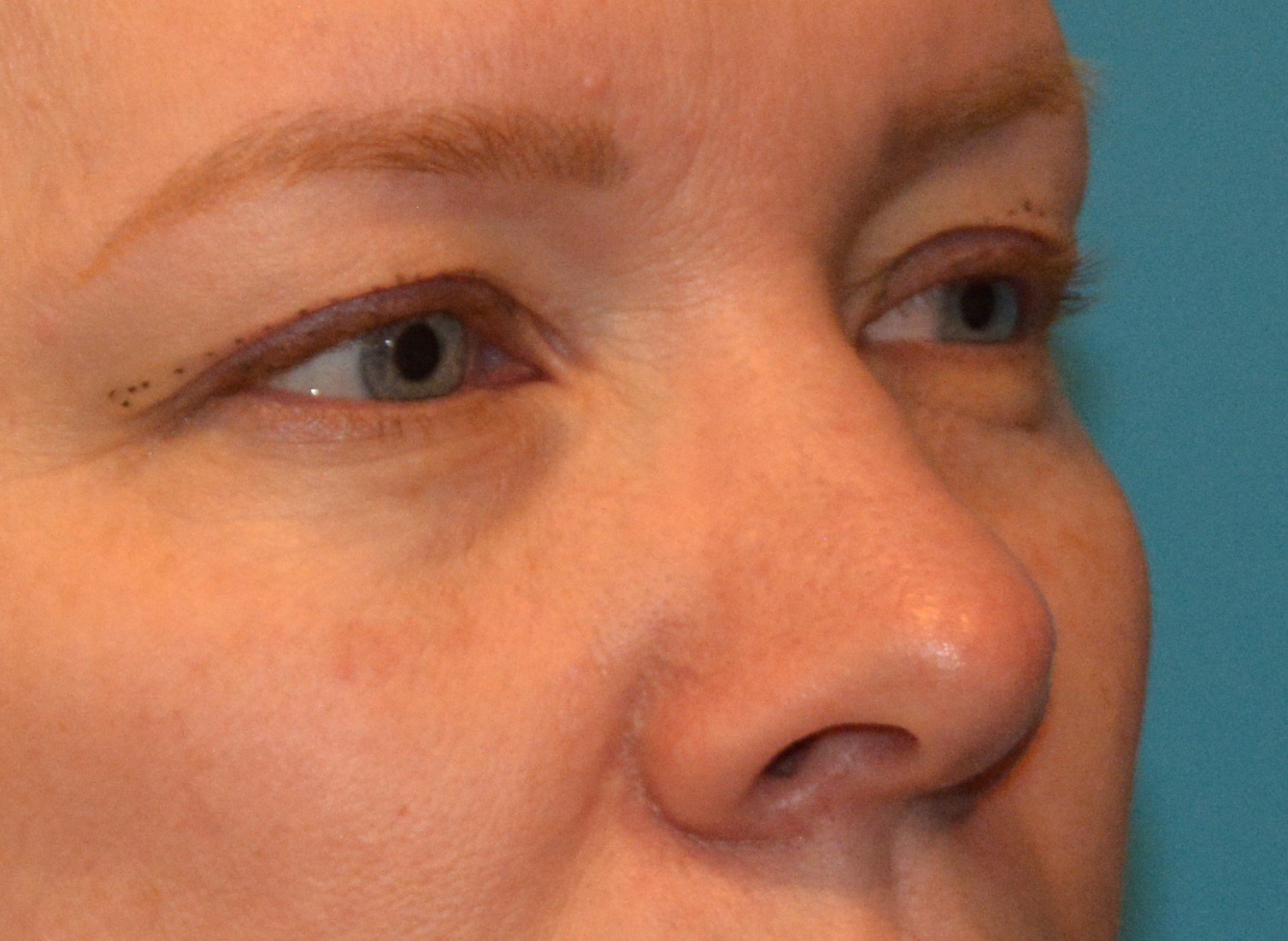 EYELID SURGERY Before
