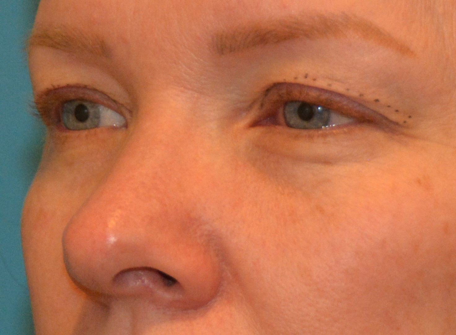 EYELID SURGERY Before