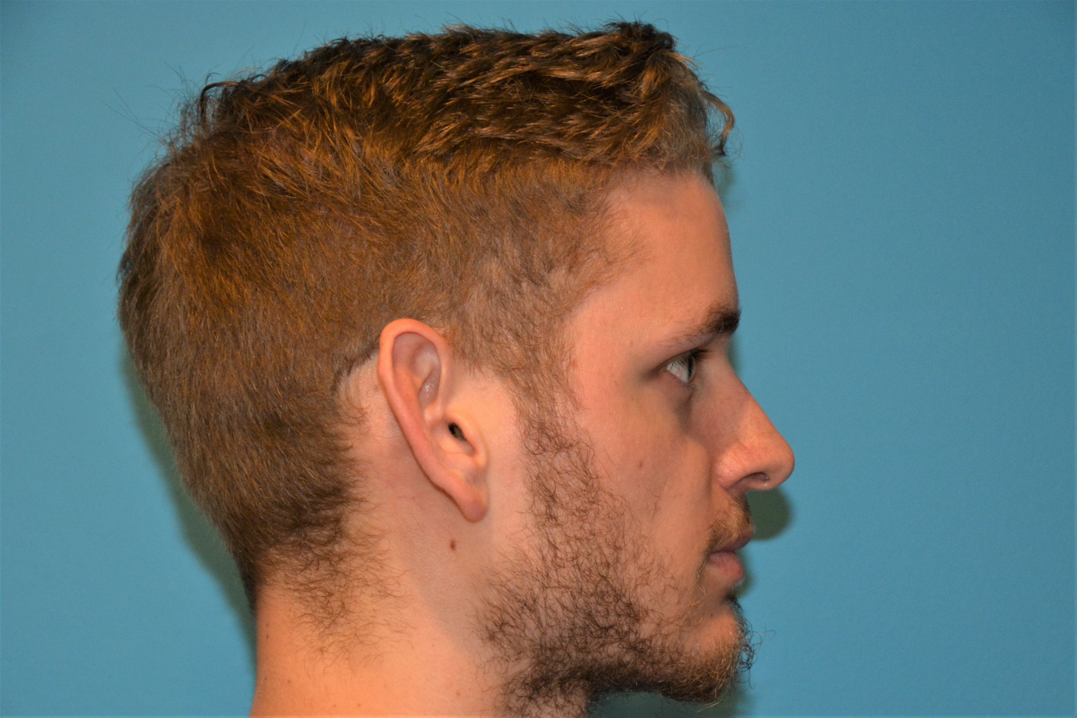 JAW SURGERY GALLERY Before