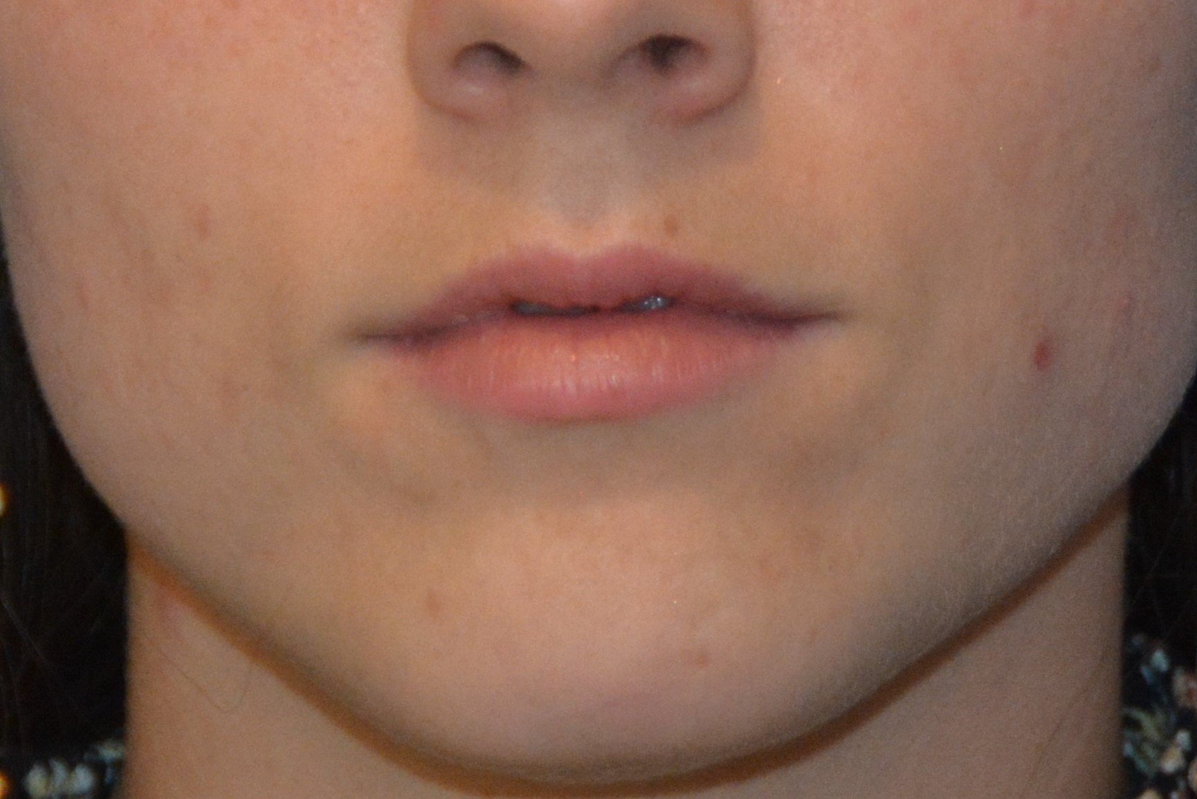 INJECTABLE FILLERS Before in West Jordan Utah