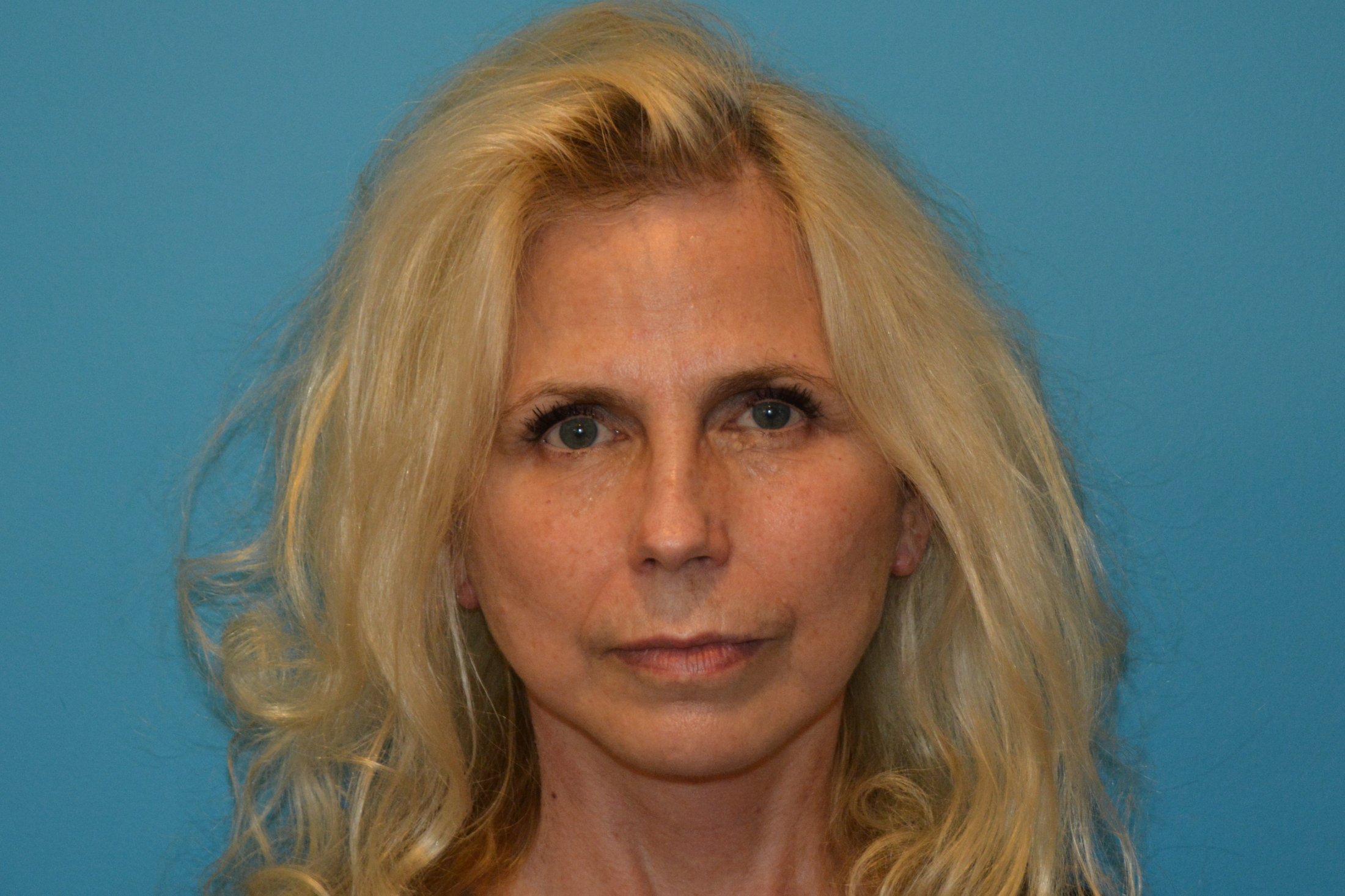 FACELIFT AND NECKLIFT After in West Jordan Utah