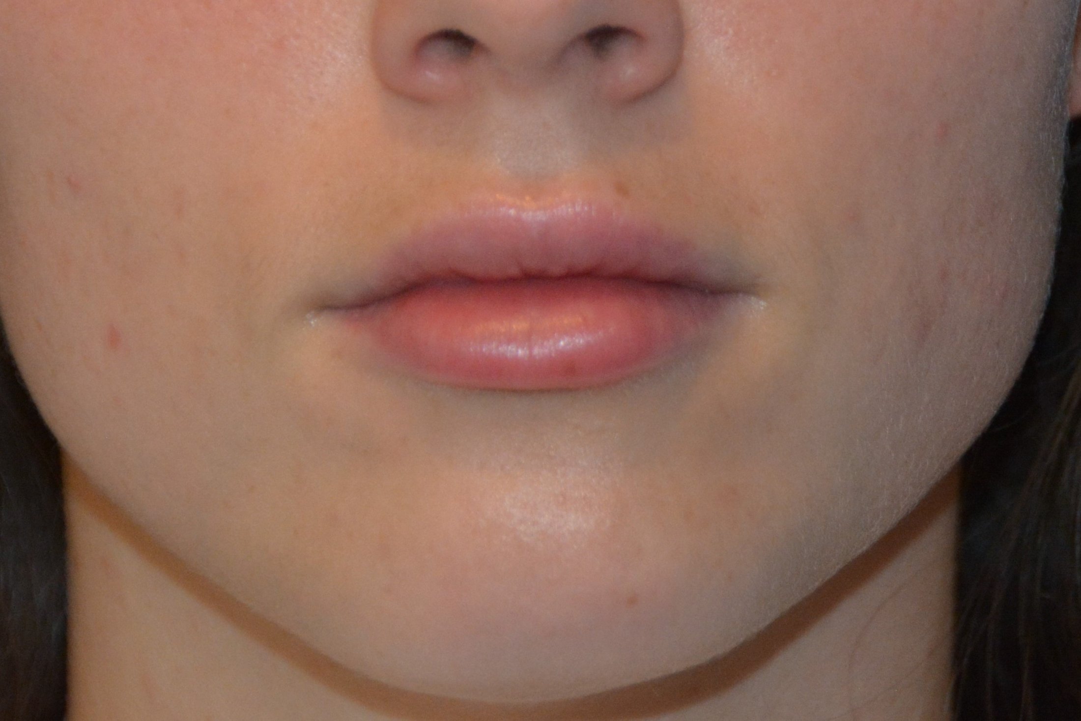 INJECTABLE FILLERS After in West Jordan Utah