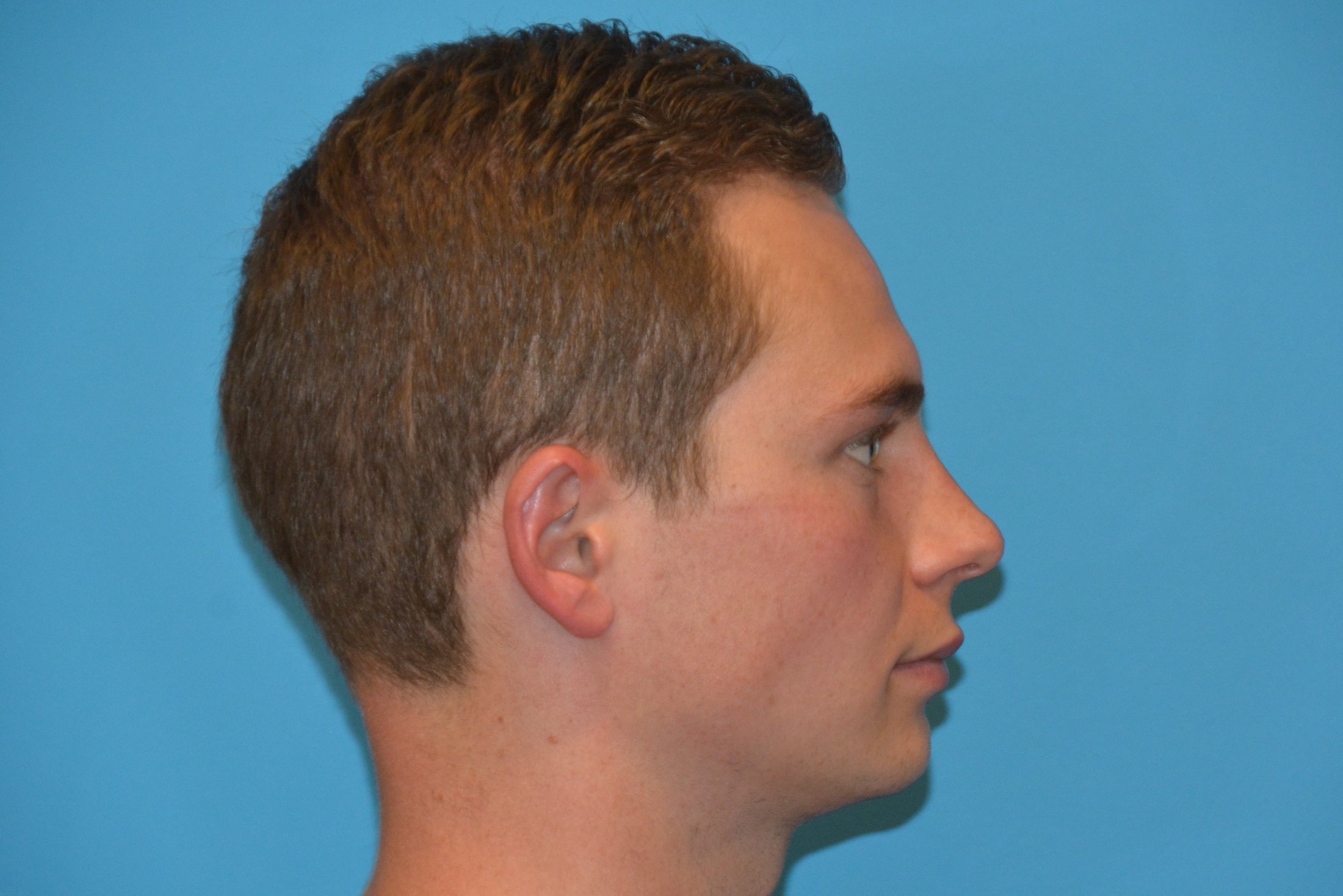 CHIN SURGERY Before CHIN SURGERY Before