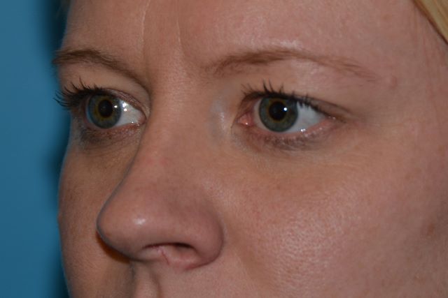EYELID SURGERY GALLERY Before