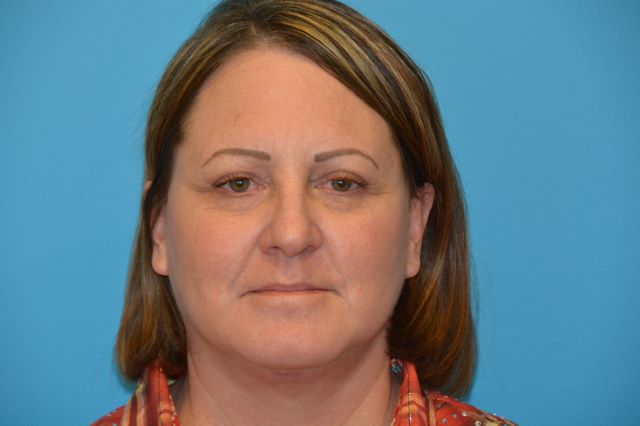 BEAUTIFY-LIFE LIFT GALLERY After