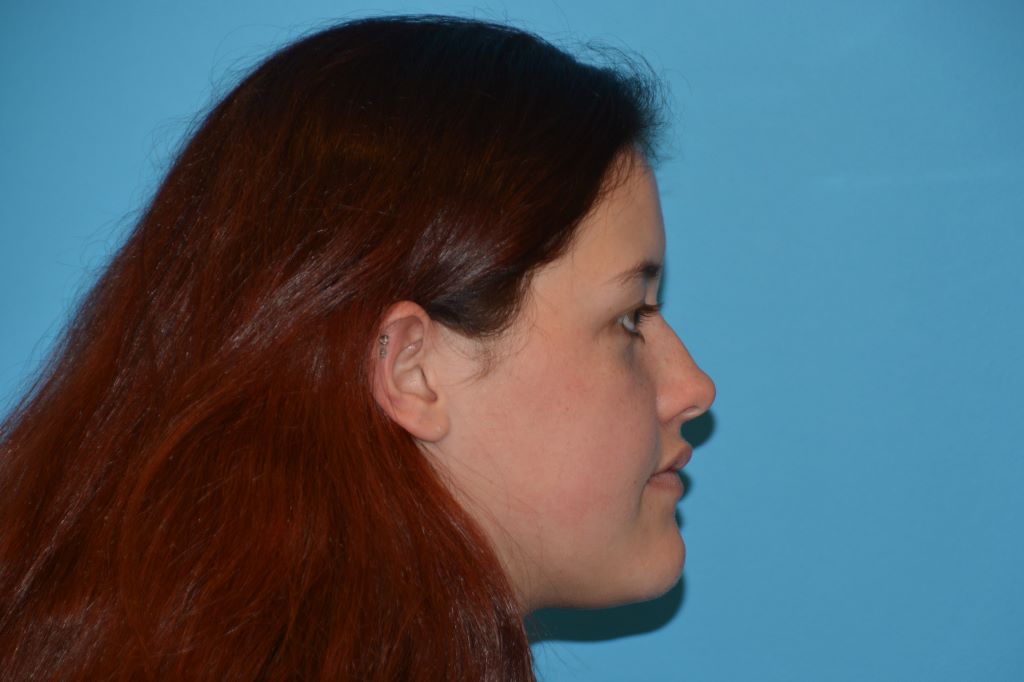 JAW SURGERY GALLERY After