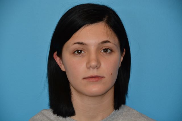 JAW SURGERY GALLERY After