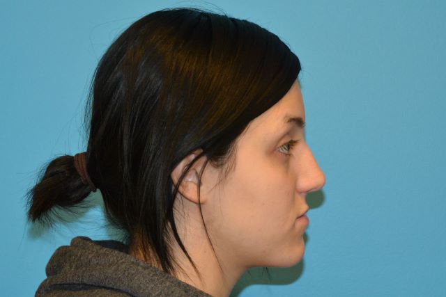 JAW SURGERY GALLERY Before