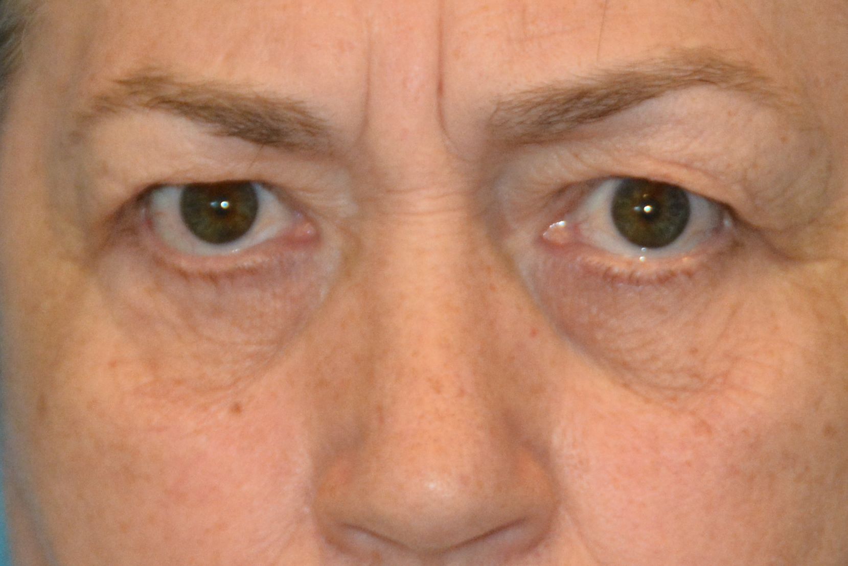 EYELID SURGERY GALLERY Before