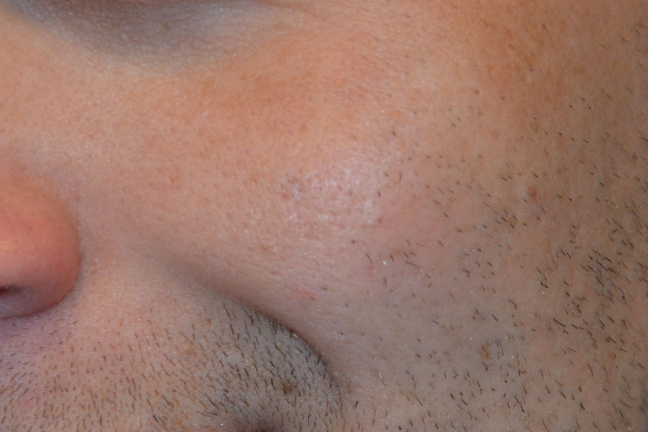 MOLE REMOVAL GALLERY in west jordan Utah