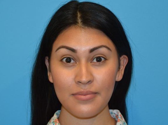 JAW SURGERY GALLERY After