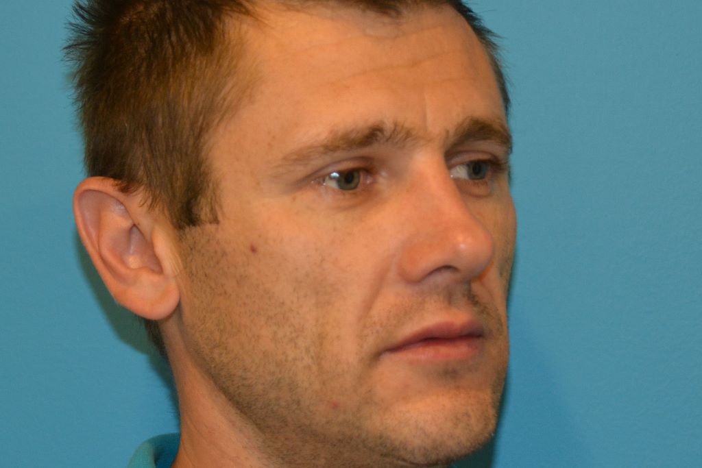 CHEEK IMPLANTS GALLERY BEFORE in west jordan Utah