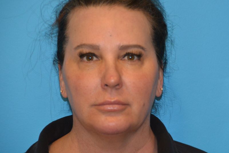 CHIN IMPLANTS GALLERY AFTER