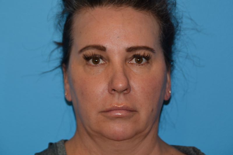 CHIN IMPLANTS GALLERY BEFORE