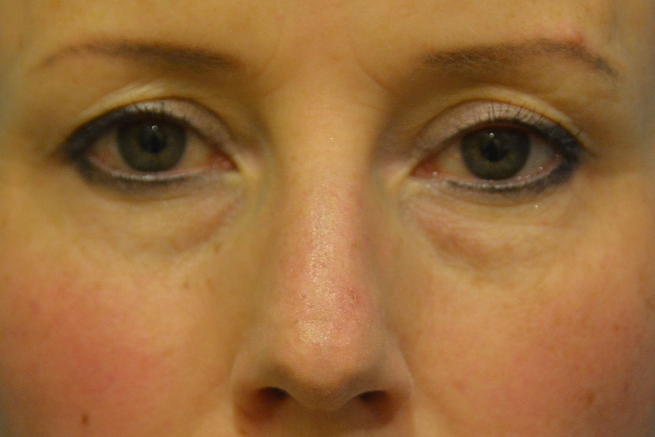 EYELID SURGERY GALLERY Before