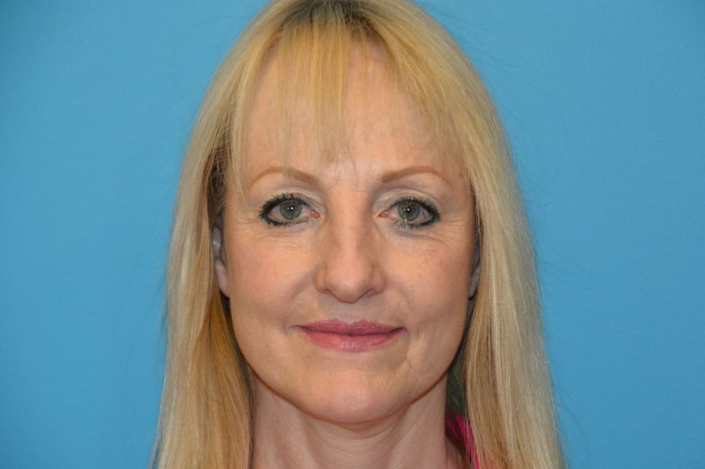 BEAUTIFY-LIFE LIFT GALLERY After