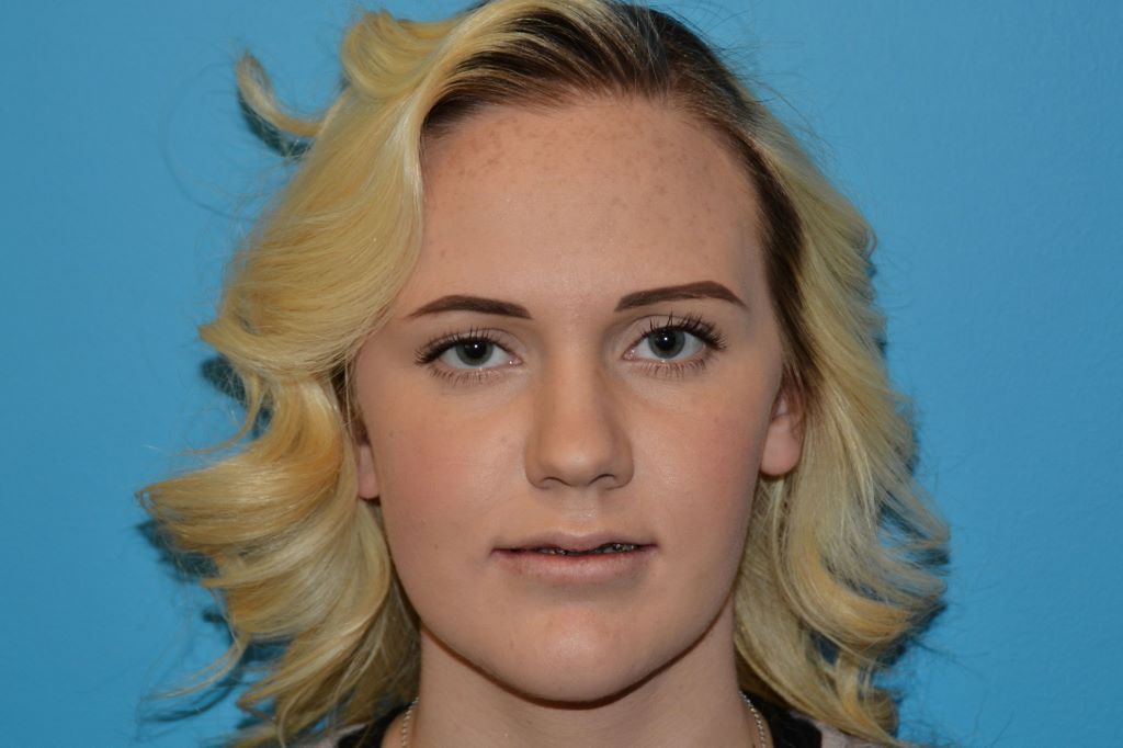 JAW SURGERY GALLERY After