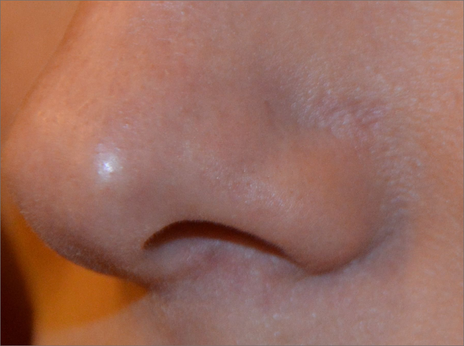 NOSE SURGERY After NOSE SURGERY After