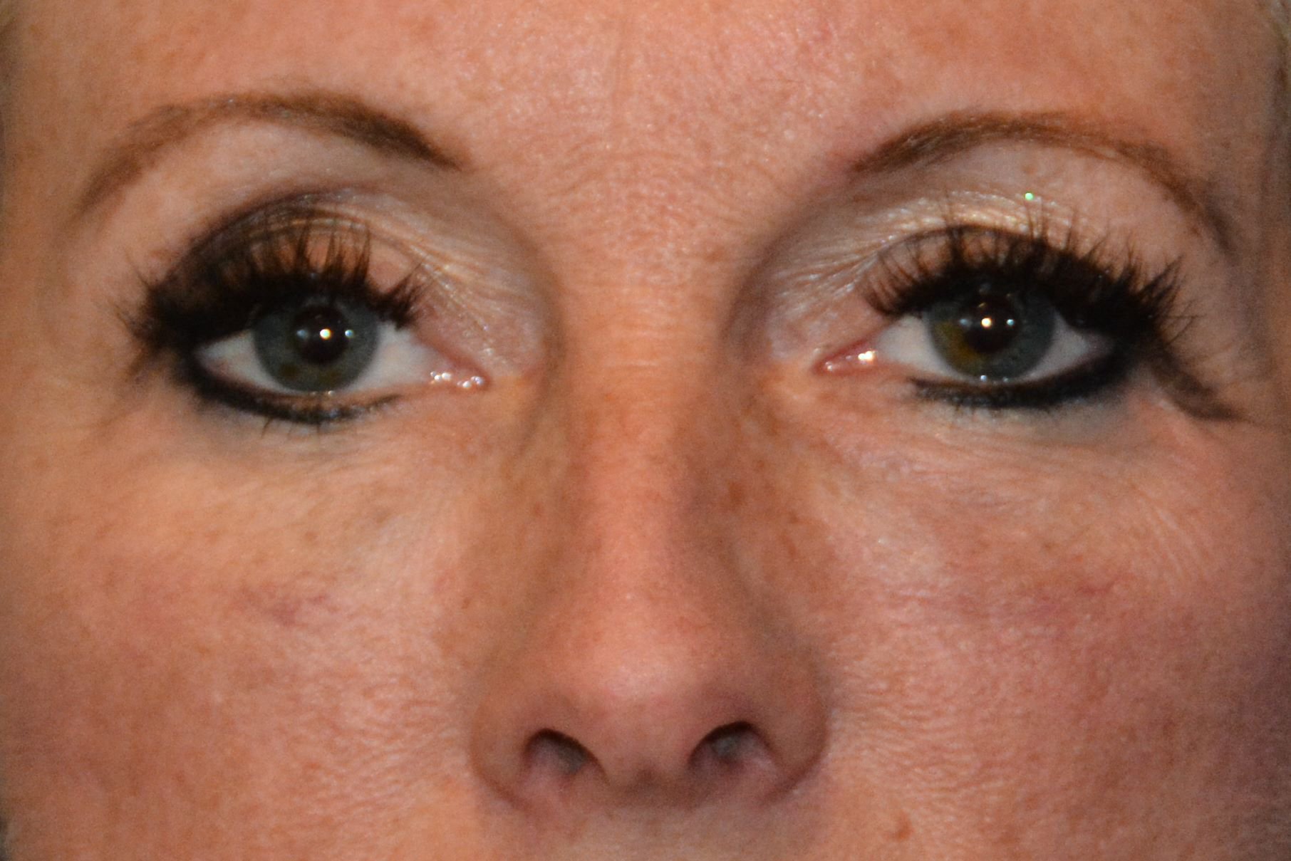 FACIAL FILLERS GALLERY AFTER