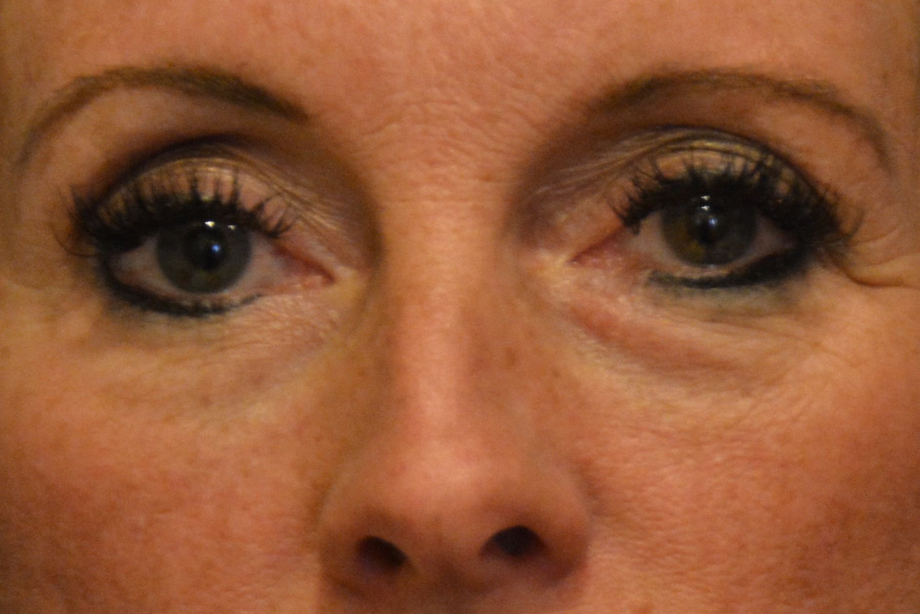 FACIAL FILLERS GALLERY BEFORE