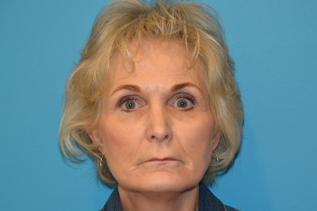 FACELIFT AND NECKLIFT before in West Jordan Utah