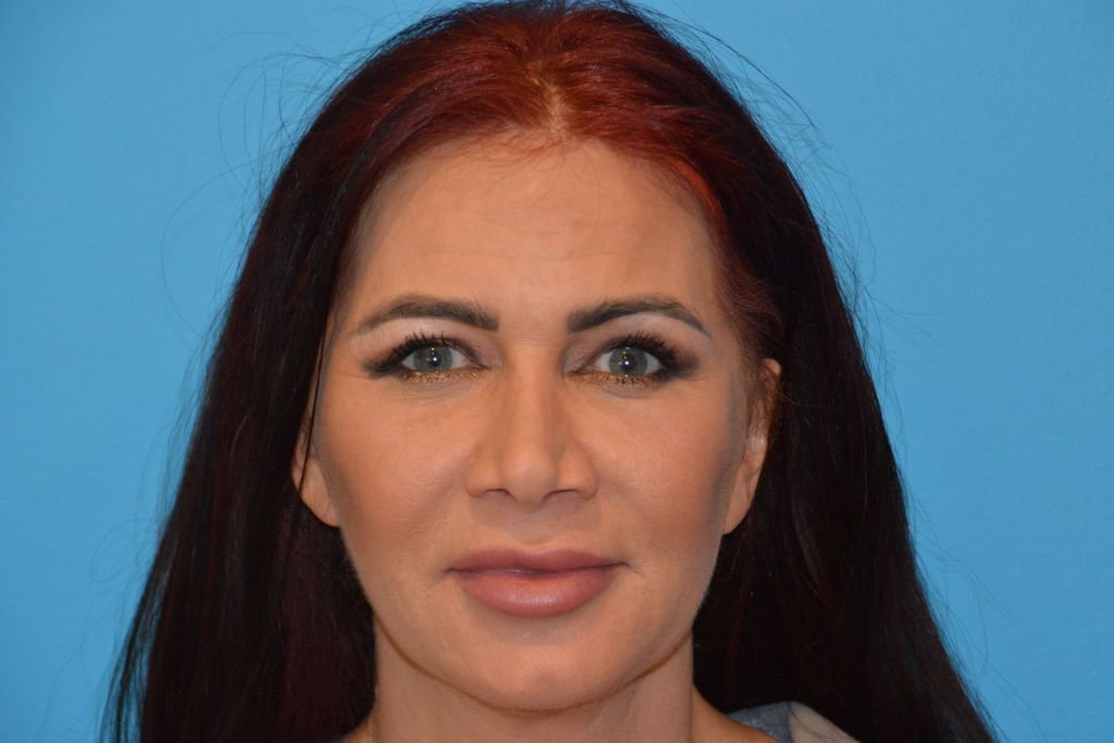 MINI FACELIFTS After