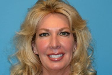 DSC_9006-1024x682_beautify-life-lift_After-379×253