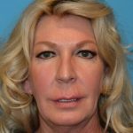 DSC_9006-1024x682_beautify-life-lift_before