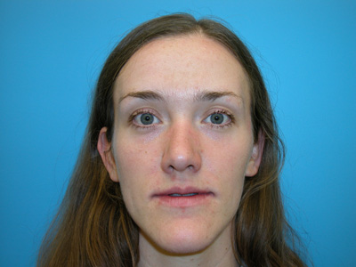 JAW SURGERY GALLERY Before