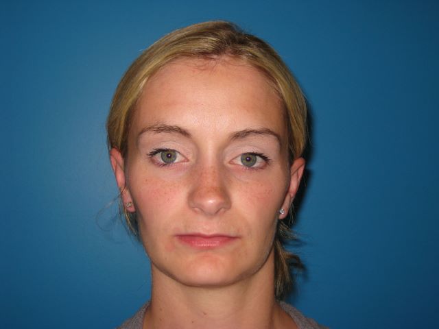 JAW SURGERY GALLERY Before