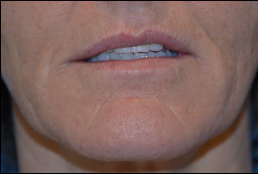 LIP AUGMENTATION GALLERY BEFORE