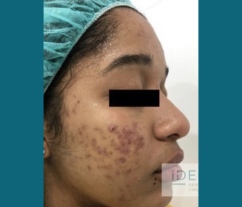 MORPHEUS8 RADIO FREQUENCY MICRONEEDLING before