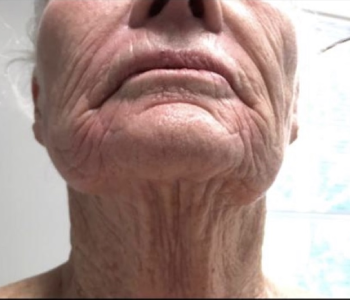 MORPHEUS8 RADIO FREQUENCY MICRONEEDLING before