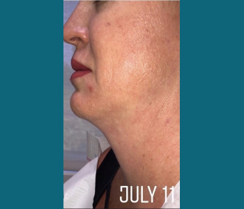 MORPHEUS8 RADIO FREQUENCY MICRONEEDLING before