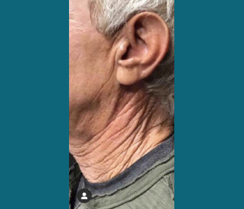 MORPHEUS8 RADIO FREQUENCY MICRONEEDLING before