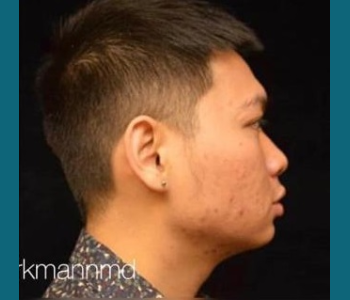 MORPHEUS8 RADIO FREQUENCY MICRONEEDLING in west jordan Utah_New Project (38)